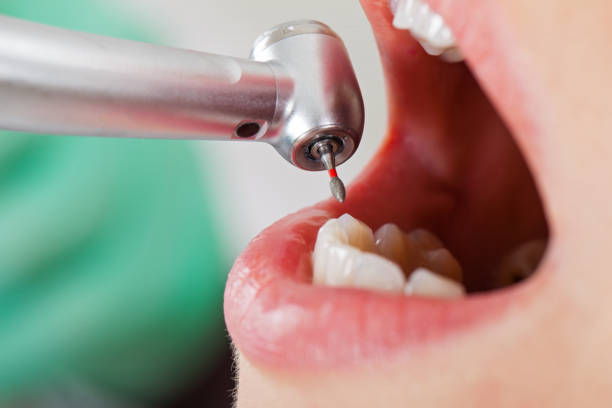 Best Emergency Dentist for Lost Fillings or Crowns in Mount Plymouth, FL